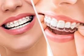 Braces & Invisalign